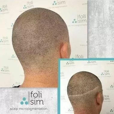 Foli-Sim-SMP-HT-scar-4